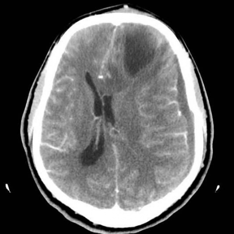Featured image of post Cerebritis Ct Scan A ct scan also called a cat scan or computed tomography scan can help doctors find cancer other names for this test
