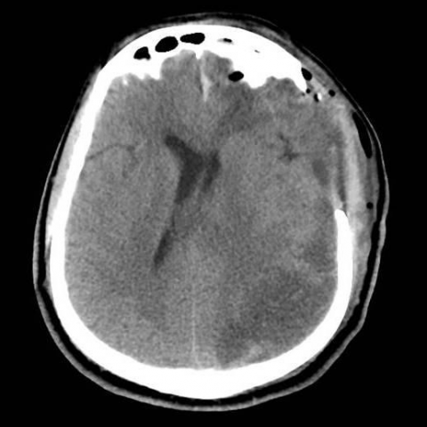 Brain abscess in a drug abuser with history of cocaine sniffing | Eurorad