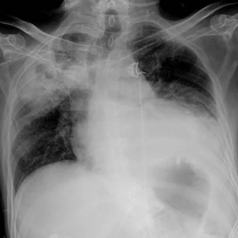 is pneumonia a form of covid