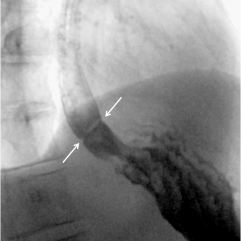 SCHATZKI'S RING OR LOWER ESOPHAGEAL WEB: A SEMANTIC AND SURGICAL ENIGMA