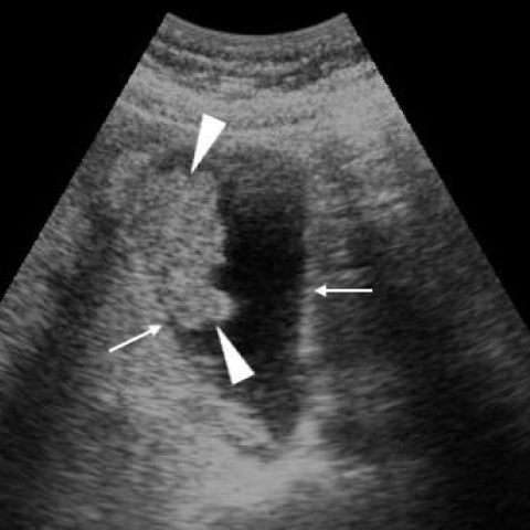 Gallbladder Mass Ultrasound