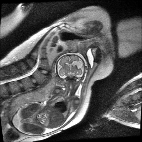 Fetal MRI of post-clastic schizencephaly | Eurorad
