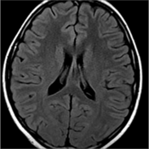 Leukoencephalopathy in children treated with high-dose methotrexate ...