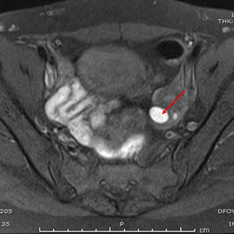 Role of MRI in Bilateral rudimentary uterine horns with endometriosis ...