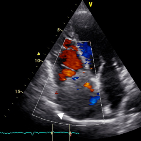A rare case of heart failure: Right atrial invasion by hepatocellular ...