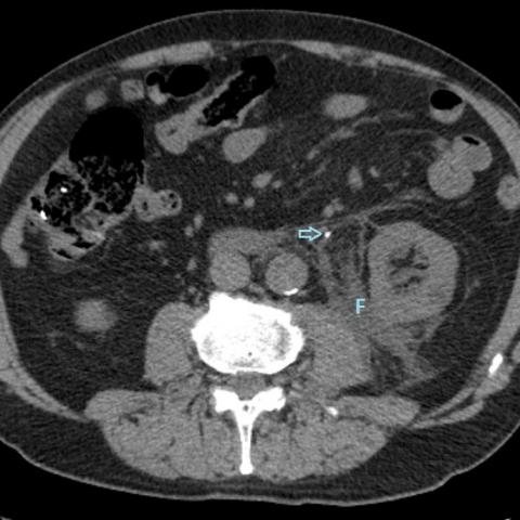Upper urinary tract rupture secondary to acute lithiasic ureteric ...