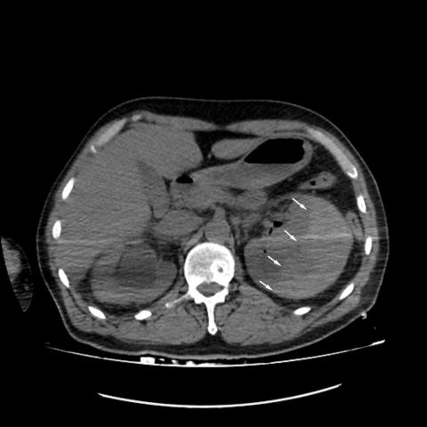 Page kidney after percutaneous nephrolithotomy | Eurorad