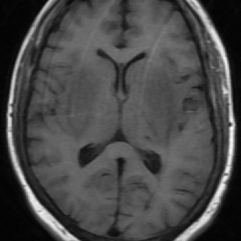 MRI brain findings in a case of uremic encephalopathy | Eurorad