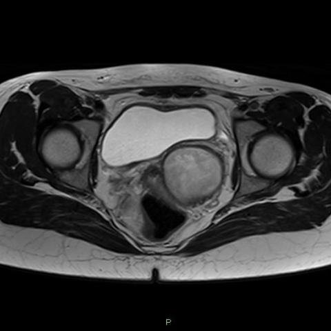 Herlyn-Werner-Wunderlich Syndrome: A case report with US, MRI and TC ...