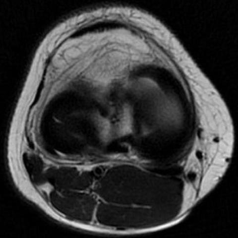 Isolated lateral meniscus tear in young Artistic gymnast athlete | Eurorad