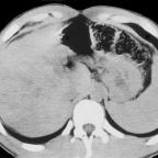 Non-enhanced CT scan of the liver