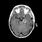 MRI Brain  2 month post anti-toxoplasma treatment