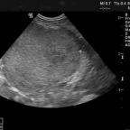 Transverse ultrasound image of right flank