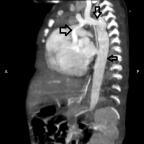 Sagittal MPR MIP image- showing the course of the entire thoracic aorta. AA and aortic root are hypoplastic with a small-size