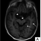 Axial sections of T1W-TSE sequence showing multiple cystic lesions at grey-white matter junctions in bilateral temporal lobes
