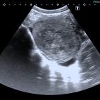 Transabdominal ultrasonography shows a well-defined solid echogenic mass with central hypoechoic areas in the right adnexa. N